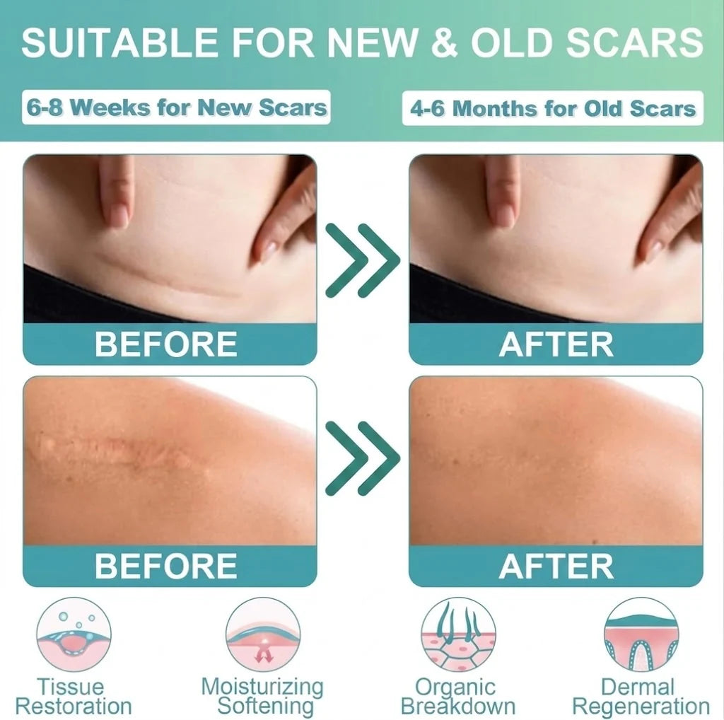 Silicone Scar Remover Tape for Acne & Wrinkles