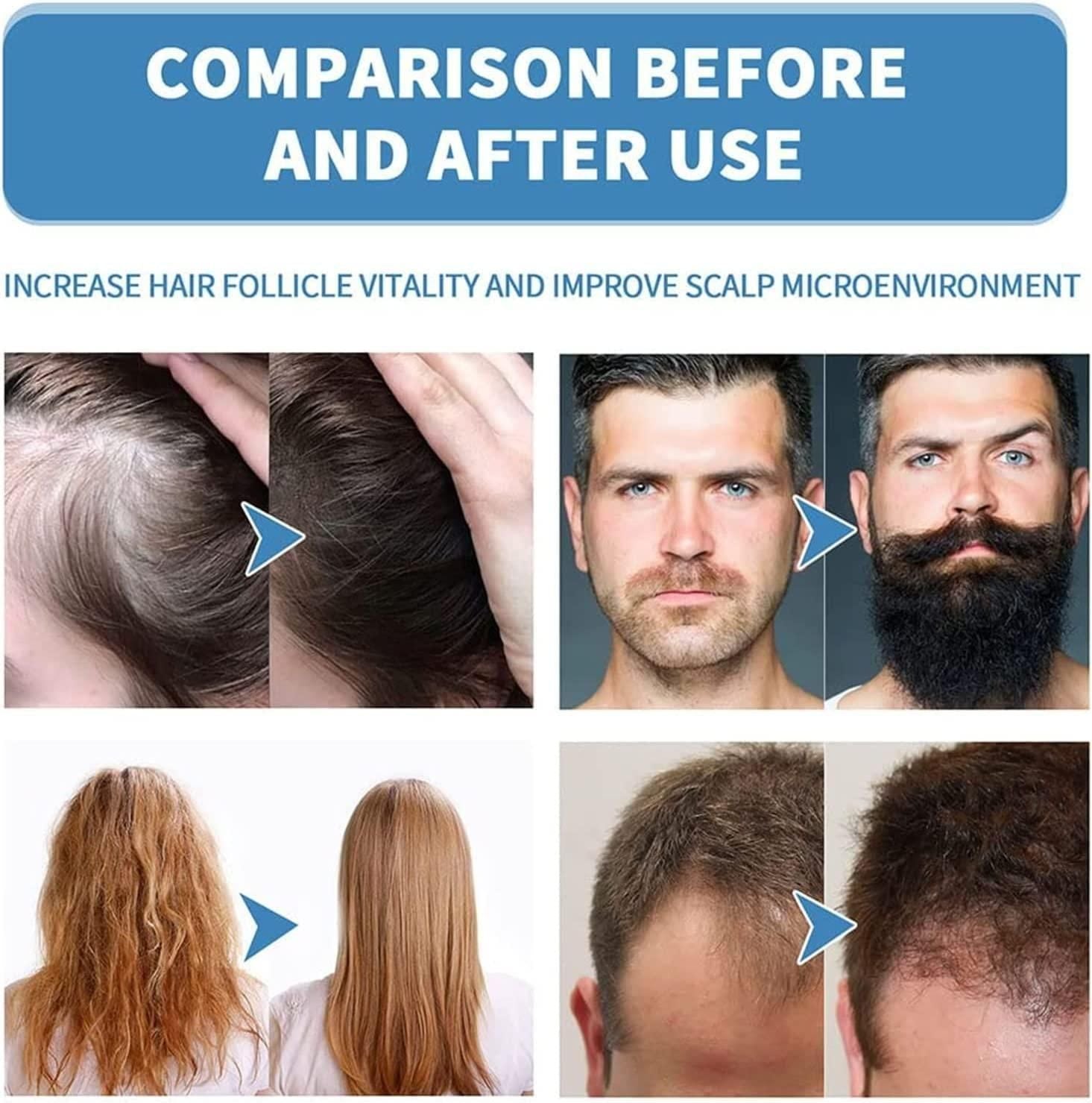 Minoxi Roll-On Hair Treatment Hair Growth Serum For Women & Men (Pack of 2)