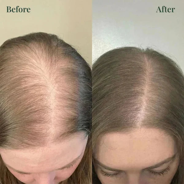 𝐊𝐞𝐫𝐚𝐫𝐨𝐬𝐞 𝐑𝐨𝐬𝐞𝐦𝐚𝐫𝐲 𝐒𝐡𝐚𝐦𝐩𝐨𝐨 𝐅𝐨𝐫 𝐇𝐚𝐢𝐫 𝐆𝐫𝐨𝐰𝐭𝐡 ( 𝐁𝐮𝐲 𝟏 𝐆𝐞𝐭 𝟏 𝐅𝐫𝐞𝐞 🔥)