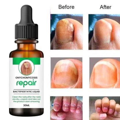 💥 Buy1Get1 Free 💥Onychomycosis Repair Bacteriostatic Liquid.
