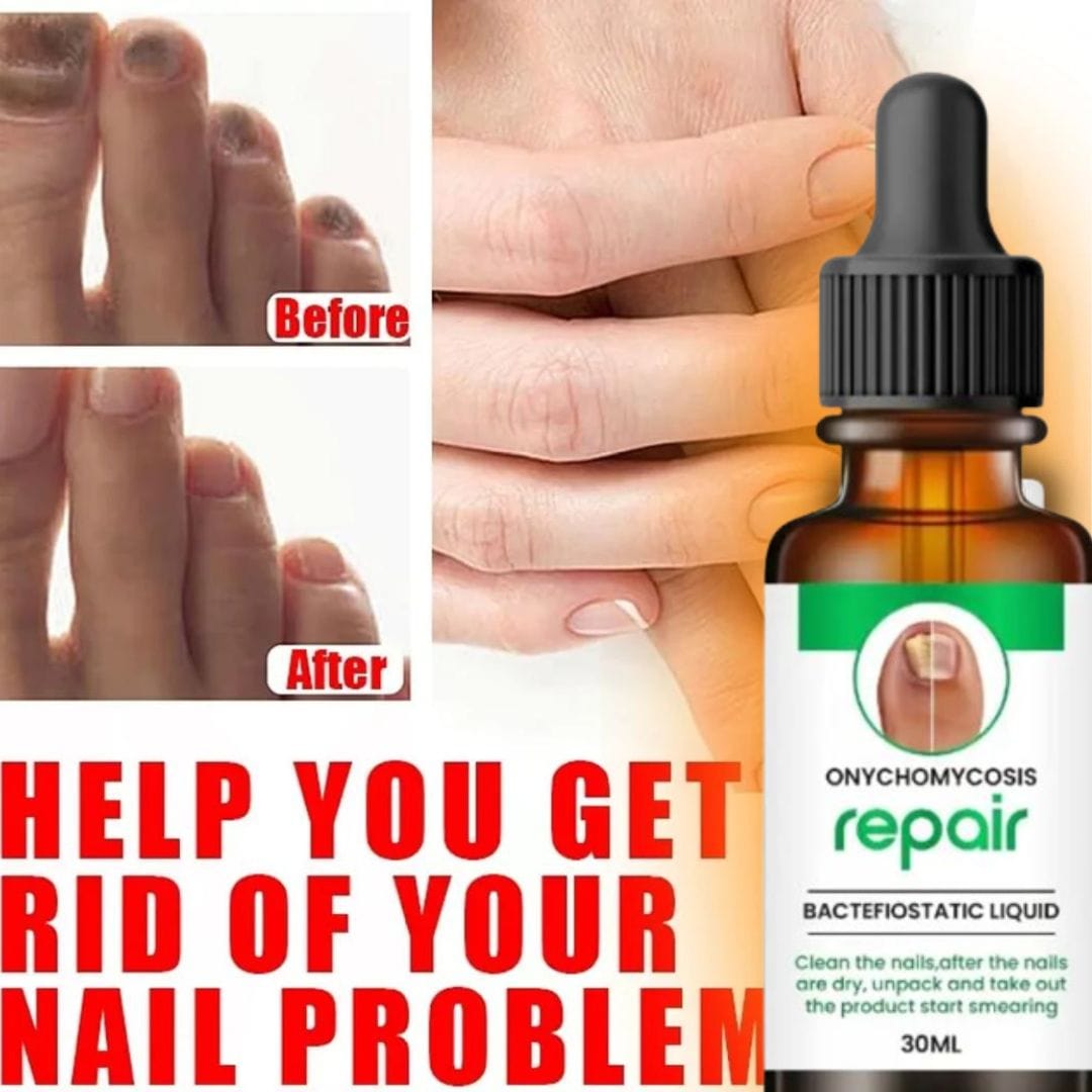 💥 Buy1Get1 Free 💥Onychomycosis Repair Bacteriostatic Liquid.