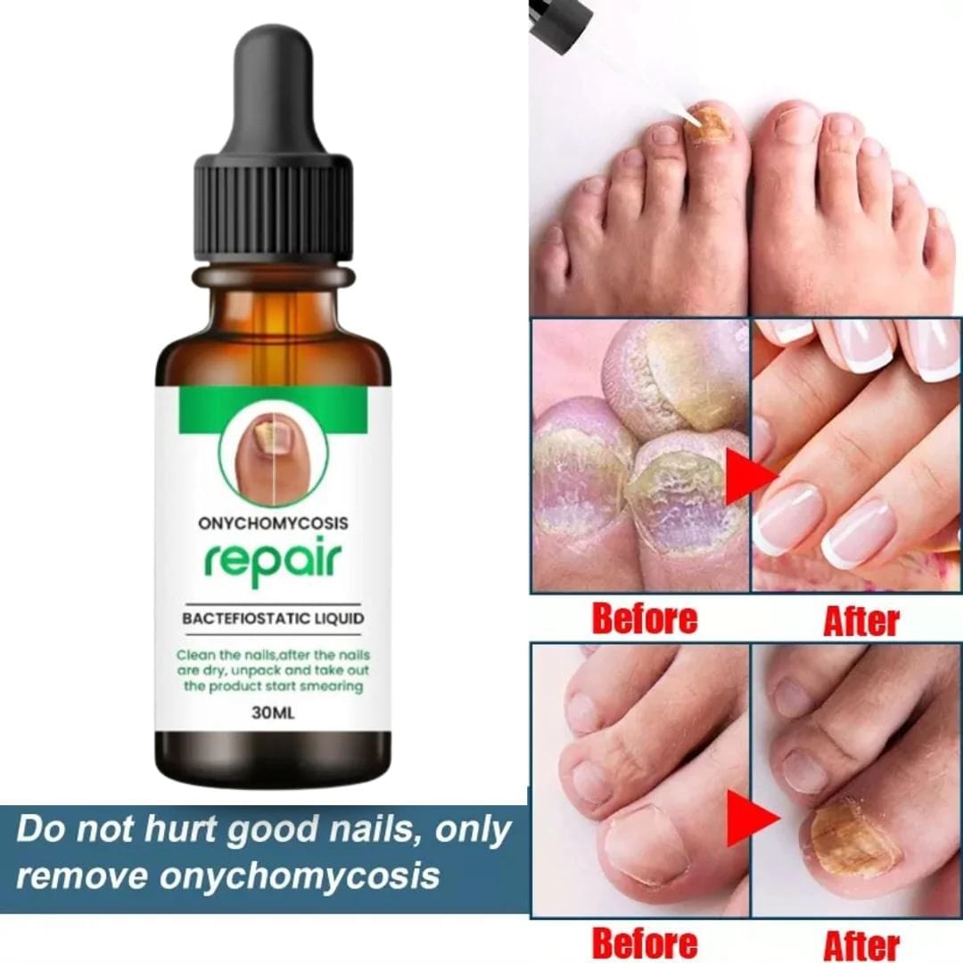 💥 Buy1Get1 Free 💥Onychomycosis Repair Bacteriostatic Liquid.