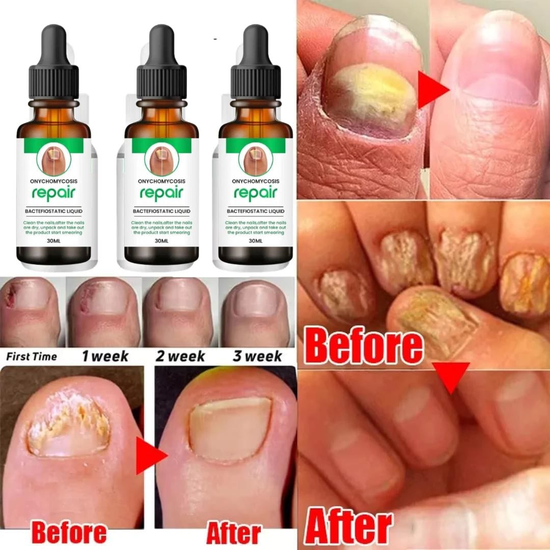 💥 Buy1Get1 Free 💥Onychomycosis Repair Bacteriostatic Liquid.